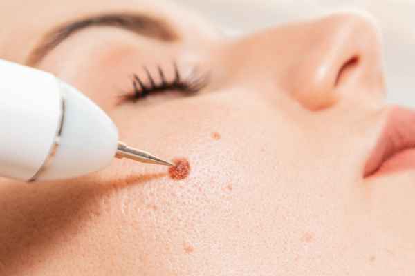 CryoPen: 5 Skin Concerns It May Be Used to Treat 3 What actually happens during a CryoPen treatment Buckhurst Hill?