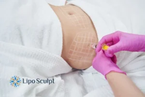 Are The Results From Aqualyx Permanent? 1 Do you want to know how long Aqualyx Buckhurst Hill results last?