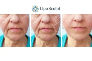 Explaining Morpheus8 And What It Can Do For You 3 Boost your confidence with Morpheus8 Buckhurst Hill call our team today!