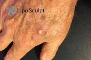 Best Actinic Keratoses Removal 2 Improve your wellbeing and health with Actinic Keratoses Buckhurst Hill removal.treatment