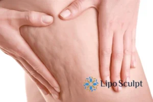 CoolSculpting for Legs: The Innovative Approach to Redefining Your Legs 5 Start your journey today book your coolsculpting treatment Buckhurst Hill online today!