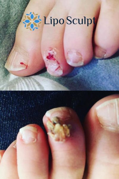 Wart removal customer results from Lipo Sculpt Buckhurst Hill
