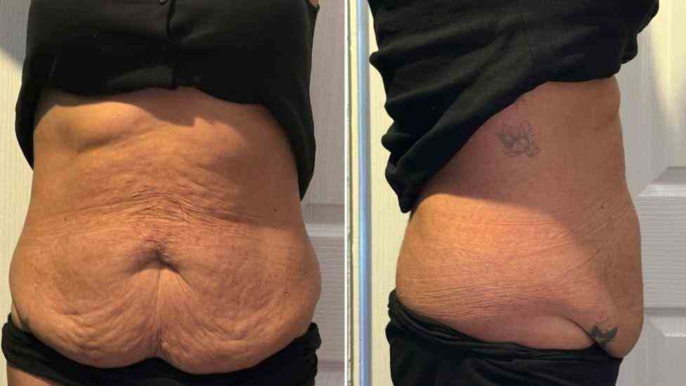 Lost the Weight but Not the Loose Skin? What You Should Know 1 Is It Definitely Loose Skin Buckhurst Hill?