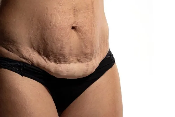 Lost the Weight but Not the Loose Skin? 1 image of womans stomach after weight loss showing loose skin Buckhurst Hill